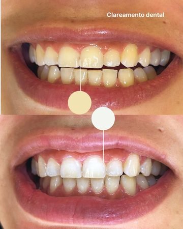 Antes e depois do clareamento dental — Sorriso mais iluminado