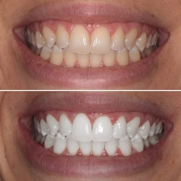 Antes e depois do clareamento dental — Mais confiança para sorrir