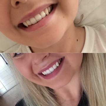 Antes e depois do clareamento dental — Tratamento personalizado