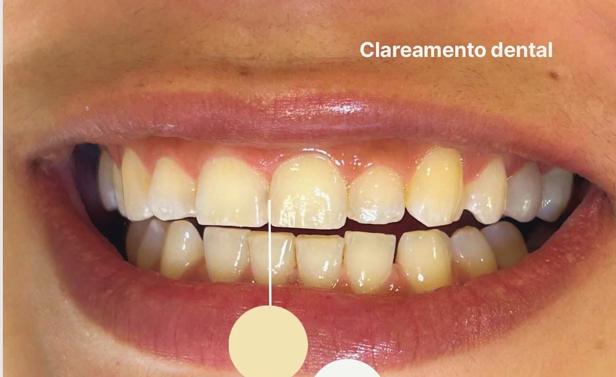 Antes do clareamento dental — caso 1