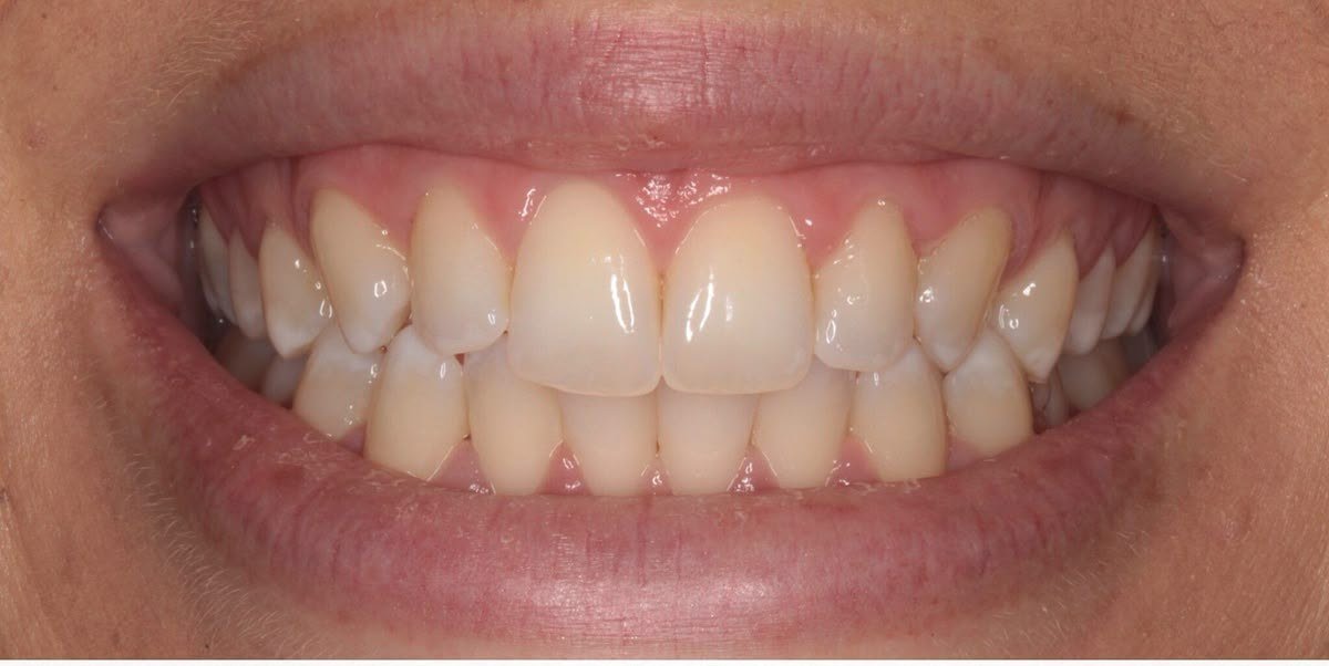 Antes do clareamento dental — caso 2