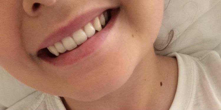 Antes do clareamento dental — caso 3
