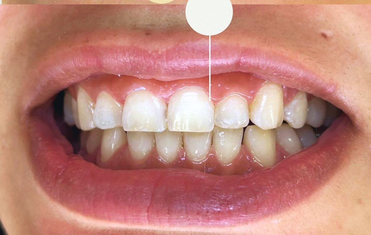 Depois do clareamento dental — caso 1