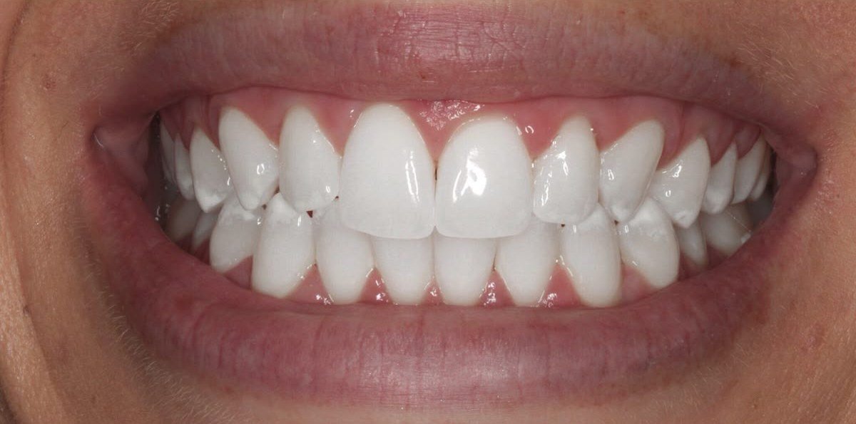 Depois do clareamento dental — caso 2